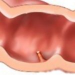 polipin çıkarılması